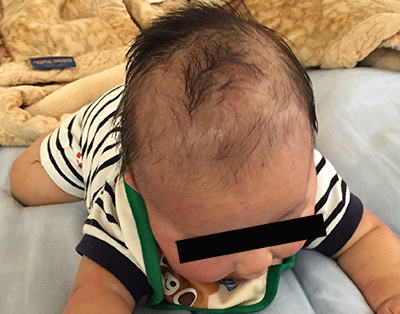 生後5か月。頭部の黄色いうろこ状の瘡蓋が剥がれて直った。地肌が現れる。いくつかの肌トラブルを経て、0歳7か月でアレルギー発覚する。（アレルギーブログの記録より）